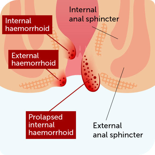 Haemorrhoids (Piles) Symptoms, Advice & Treatment